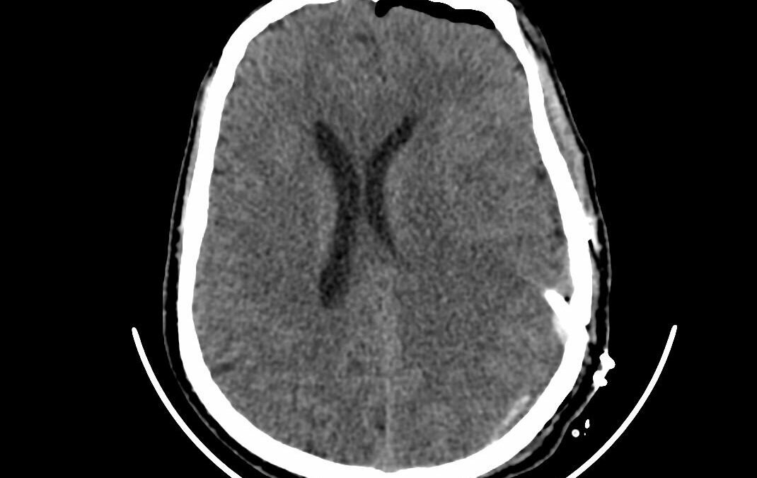 مستشفى الملك عبدالعزيز بمكة يجري عملية دقيقة بالمايكروسكوب والمنظار لخمسيني