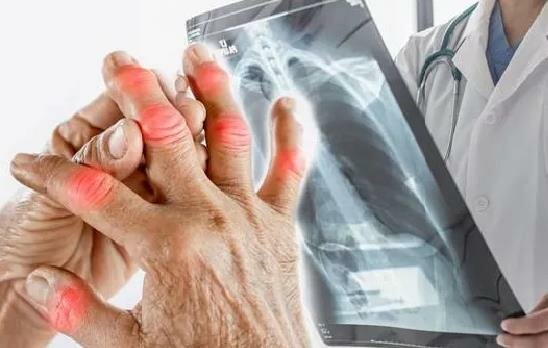 أعراض في الأصابع والوجه والرقبة والكتف تدل على الإصابة بـ”سرطان الرئة”