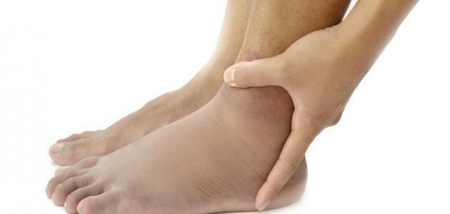هذه الأسباب الستة تؤدي لحدوث تورم في القدمين
