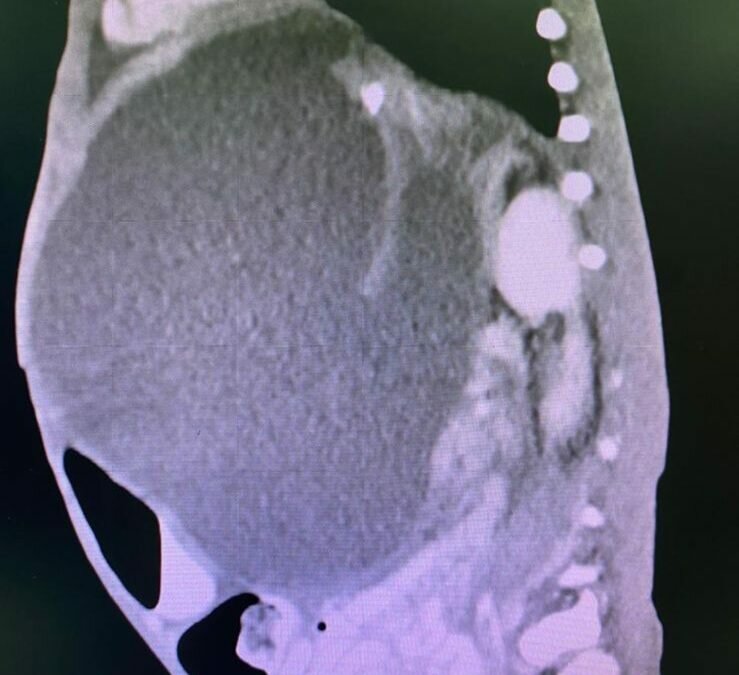 ولادة مكة تنهي معاناة طفل الثلاث سنوات من انتفاخ البطن وفقدان الوزن