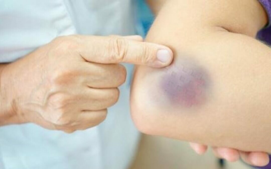 أسباب ظهور البقع الزرقاء على الجسم