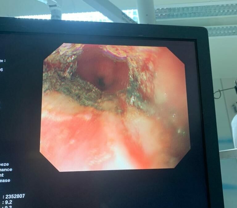 فريق طبي بولادة مكة ينجح في إنقاذ حياة طفلة إبتلعت بطارية حارقة