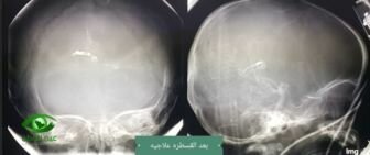 عيب خلقي نادر في المخ يهدد طفل بالنزيف و العلاج بمستشفى السعودي الألماني